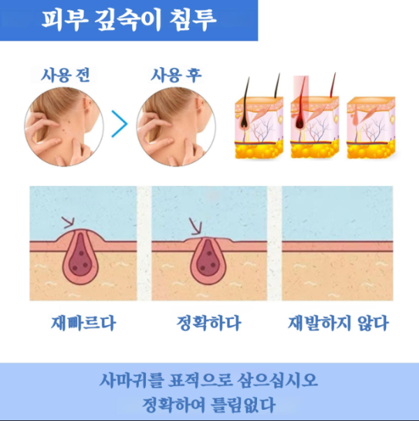 1+1 wart removal cream - Image 3